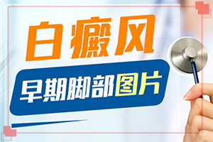 白癫疯是怎样引起的,发生的原因是什么(因为什么患上)