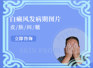 女人白斑是怎么引起的(具体的诱因有哪些)-白癜风需要检查那些