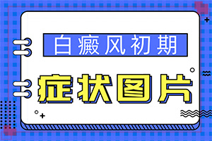 白斑增多是怎么回事,哪些诱因会导致白癜风(如何了解白斑病发)