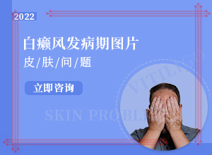 怎么检查白癜风发病原因？白班病怎么引起的-这些原因是啥呢