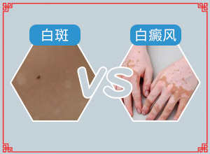 为什么脸上有一块白(有什么特点呢)-白癜风通过什么检查