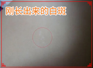 「排名前十公布」皮肤表面出现白色斑点是怎么回事？身上有白块怎么回事
