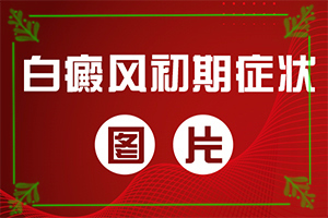长白点癫风的原因,诱发的原因有(什么原因会诱发)