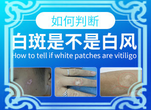 小孩脖子上有白斑是什么原因,常见原因(具体诱因致使白斑)