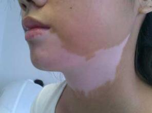 白癜风正确护理从哪些方面入手