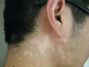 如何护理白斑,得白癜风了要在生活中注意什么