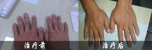 白癜风是患者的心头大患