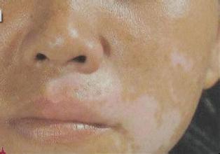 脸上有白斑需要怎么治疗 脸上有白斑需要怎么治疗