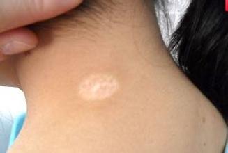 白斑怎么治,早期白癜风如何治疗比较好