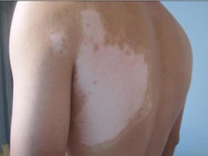 白癜风怎么治,胸部上有白癜风如何治疗 白癜风怎么治,胸部上有白癜风如何治疗