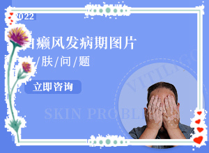 「患者须知」如何对白癫进行治疗？白癜风该怎么治疗好