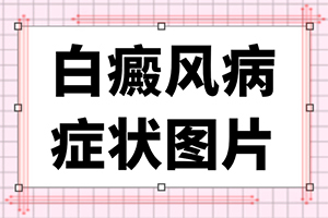 白斑怎么治疗有效？什么好处能治