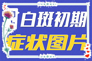 白殿疯是怎样治疗[日榜]治疗白癜风花费多少钱