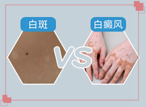 有什么方法治疗白癜风？哪些方面治疗好