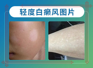 肛门白斑是怎样引起的怎么治疗[什么好处能治]治疗白斑真的吗