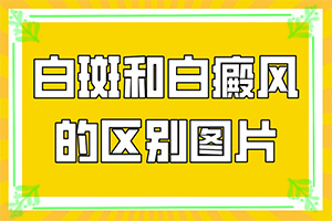 白癜风如何治？刚出现需要怎么治疗