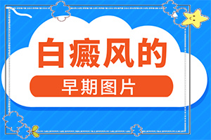 「新闻播报」手部有白斑怎么治疗？白殿疯治疗方法