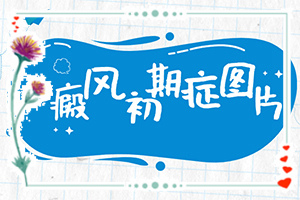 「白瘕风能治疗好吗？治了几个疗程」对白癜风的治疗有帮助吗？怎么控制才好