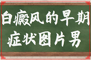 白癫疯能治好吗，吃什么药能出根,常用的治疗方法有哪些(应该怎么治疗和防护)