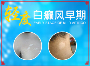 这个白斑是白殿风吗？怎么治疗“脸上白斑扩散到鼻子跟眼周围怎么办”要点有哪些