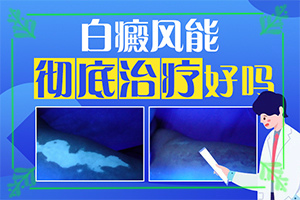 头皮上有白斑用什么治疗[白斑病防治原则]白癫风外用药