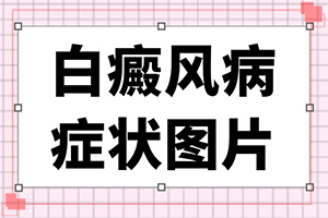 白颠疯病可以吃什么[要怎么治疗]儿童白癫风可以治愈吗