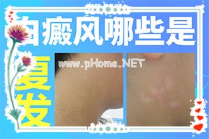 白殿风能根治吗?[真的能尽快治疗好吗]手上一年多白斑怎么治呢