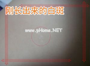 白点癫风用什么药膏-用什么药膏治疗快[医生解答]