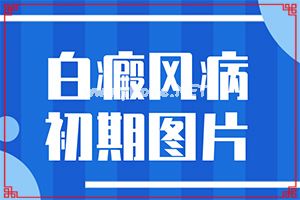 （白风）白癫疯会传染吗-怎样控制白斑不扩散