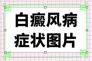 白殿疯应注意什么-存在的问题及应对建议[治疗要点]