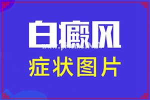 治疗白斑哪家好-做好这些即可[介绍方法]