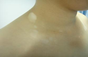 白癜风发病初期症状特点是什么 白癜风发病初期症状特点是什么