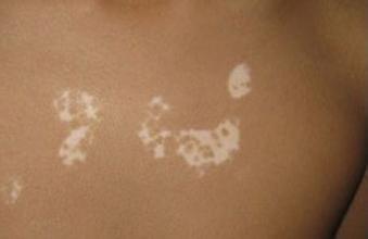 白癜风早期有什么样的症状 白癜风早期有什么样的症状