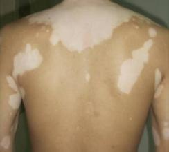 白斑是什么样的,手上白癜风有什么症状 白斑是什么样的,手上白癜风有什么症状