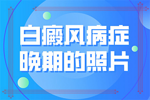 儿童白斑病早期症状图片？白斑症初期图片-得了会有什么特征