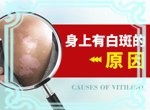 口腔白斑图片初期症状图片,是什么样子,有图吗?(怎样判断症状)
