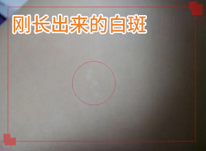 白癞风早期图片,几个基本表现(如何确定白斑是不是白癜风)