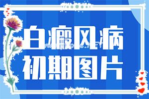 （白颠癫风）白疯癫早期的图片-成乳白色